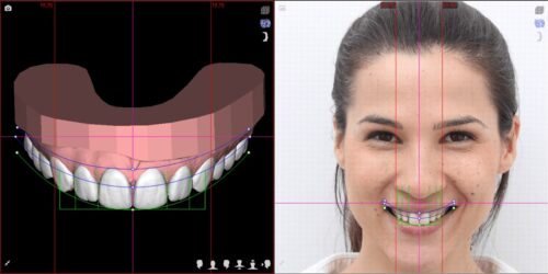 Lente de porcelana e DSD Digital Smile Design