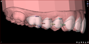 Lente de porcelana e DSD Digital Smile Design