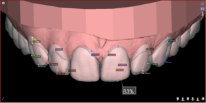 Lente de porcelana e DSD Digital Smile Design