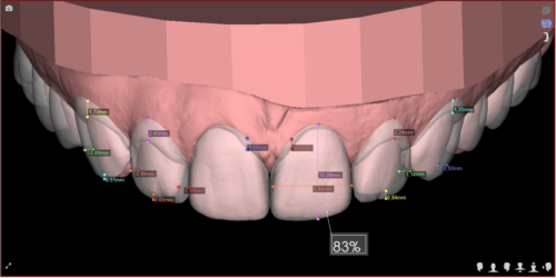 Lente de porcelana e DSD Digital Smile Design