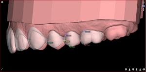 Lente de porcelana e DSD Digital Smile Design