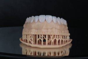 Lente de porcelana sorriso hi-tech DSD