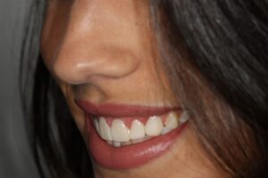 Lentes de contato dental, que é esse tratamento?