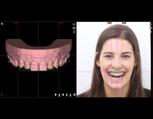 Mais do que estética, seu sorriso confiante com lente de porcelana