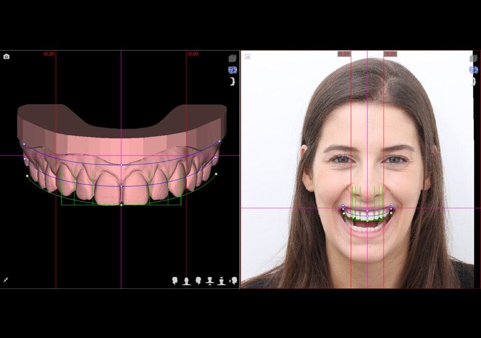 Mais do que estética, seu sorriso confiante com lente de porcelana