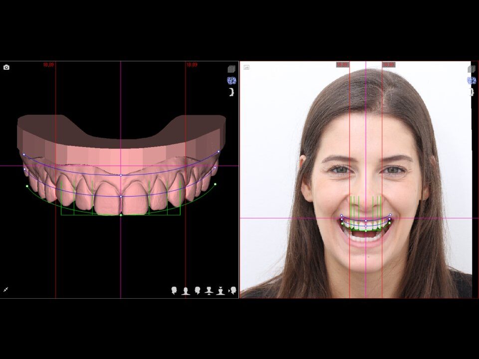 Mais do que estética, seu sorriso confiante com lente de porcelana