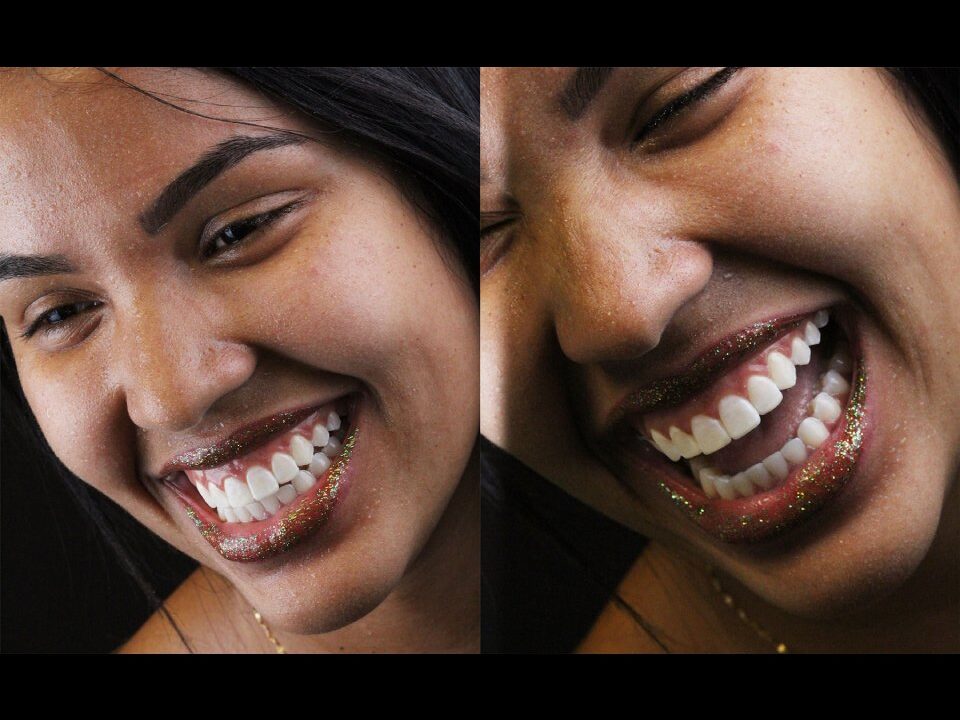 Sorrisos em cada detalhe, com lente de porcelana